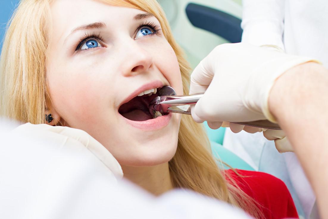 Tooth Extraction San Jose, CA